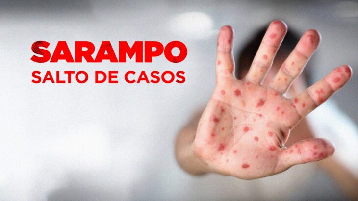 Saúde em risco: como o discurso antivacina pode reabrir as portas para o sarampo no Brasil